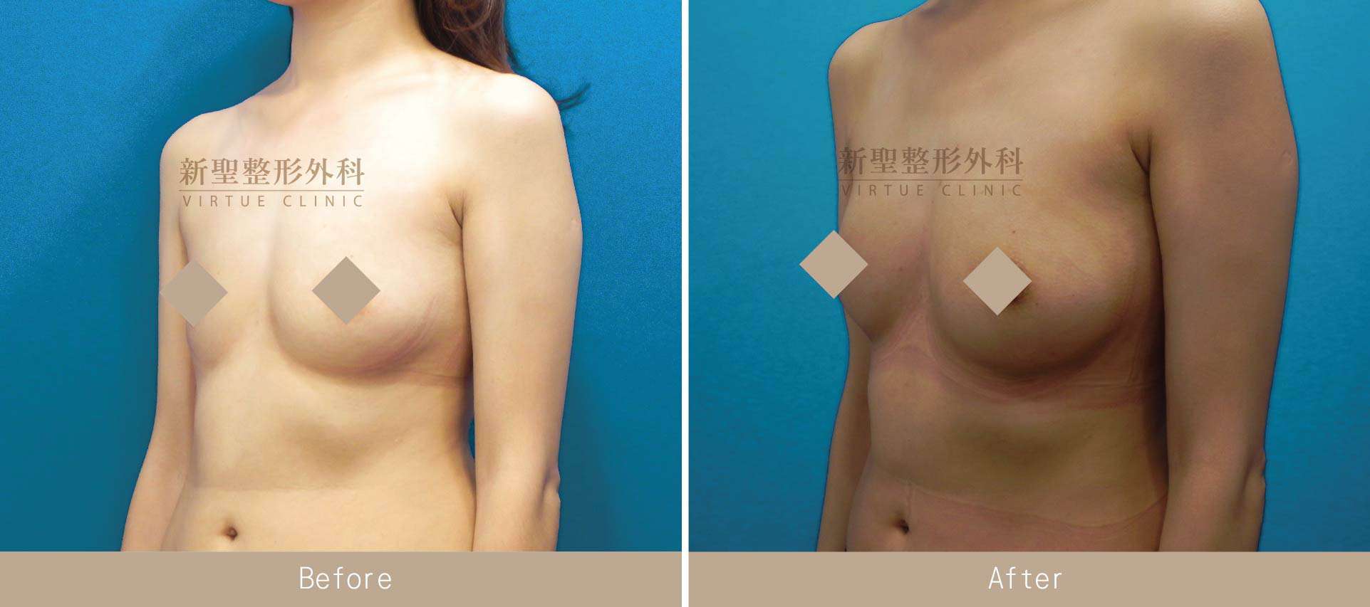 自體脂肪隆乳手術案例照片