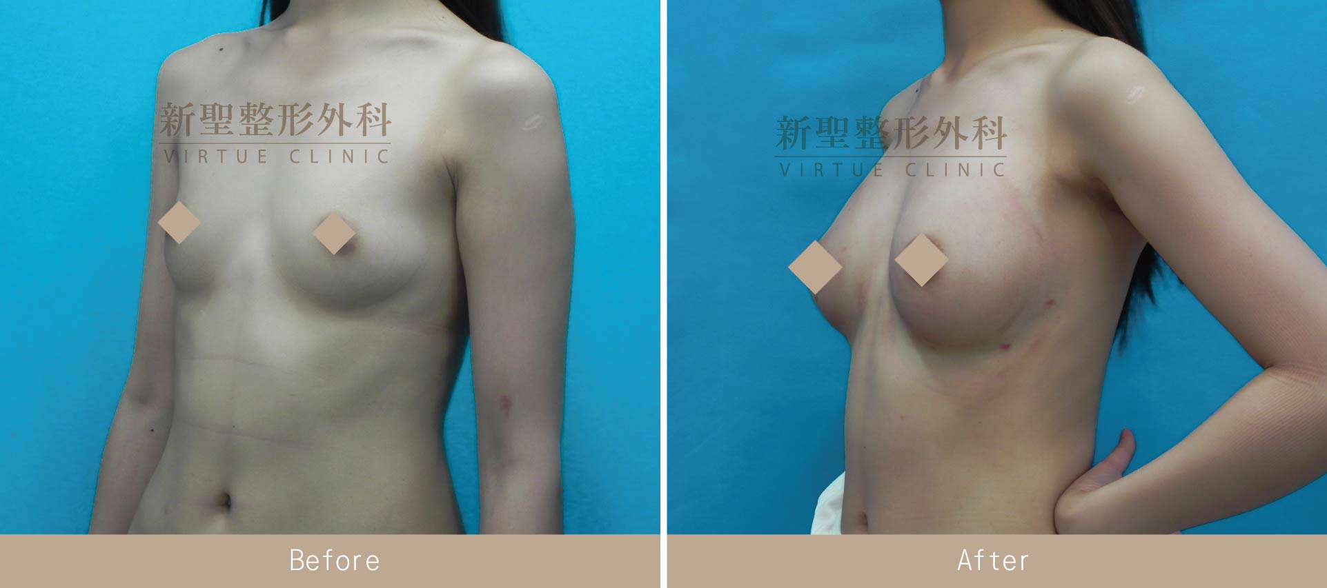 自體脂肪隆乳手術案例照片